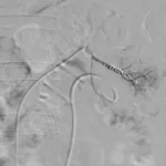 TRIHMS performs first-ever RI treatment of renal artery pseudoaneurysm