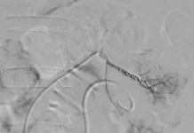 TRIHMS performs first-ever RI treatment of renal artery pseudoaneurysm
